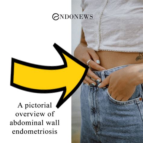 endometriosis in abdominal wall